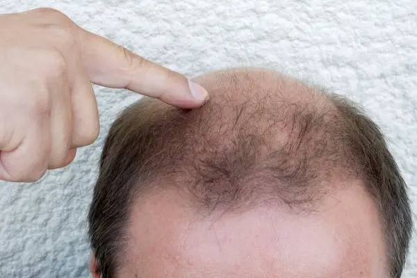 נשירת שיער אצל גברים